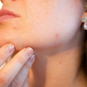 Comment éliminer et se débarrasser de l’acné ?
